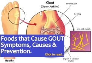 Foods that Cause GOUT Arthritis Gout Symptoms, Causes and Prevention
